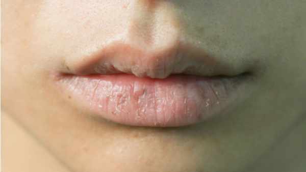 Penyebab dan 4 Cara Mengatasi Bibir Kering