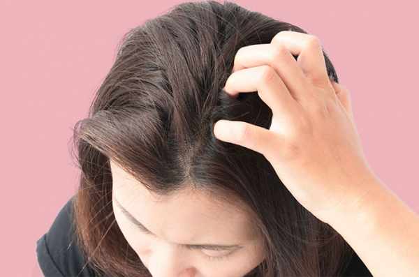 Penyebab dan Bahan Bahan Alami untuk Mengusir Kulit Kepala Gatal